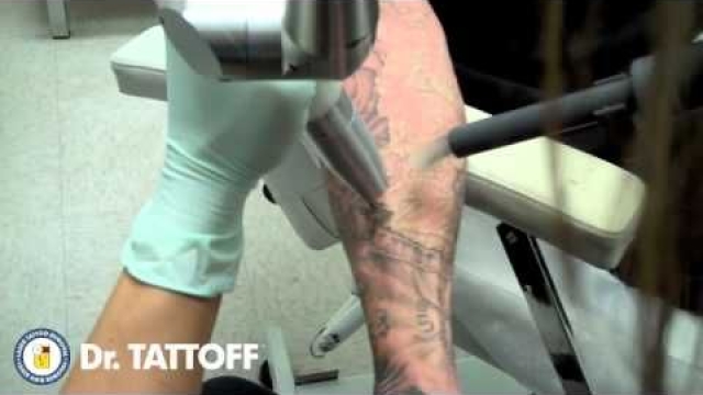 Tattoo Removal – What Is On Hand For Pain, Cost And Results