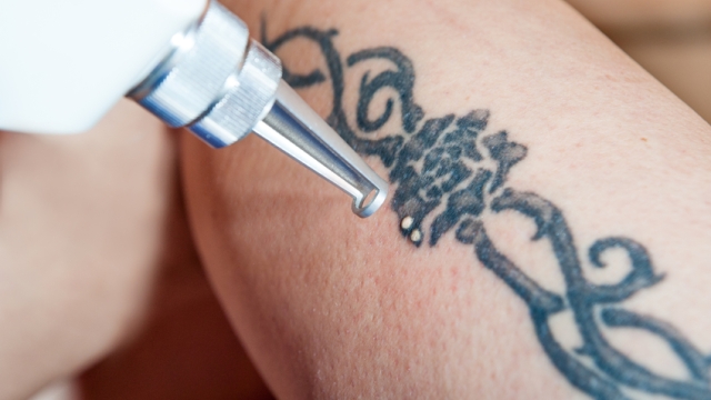 The Very High Cost Of Tattoo Removal