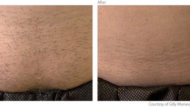Flawless and Fuzz-Free: Unleashing the Magic of Laser Hair Removal