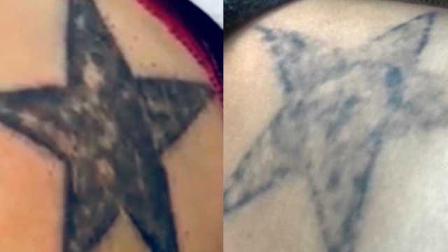 Tattoo Removal – Be Free From That Tat