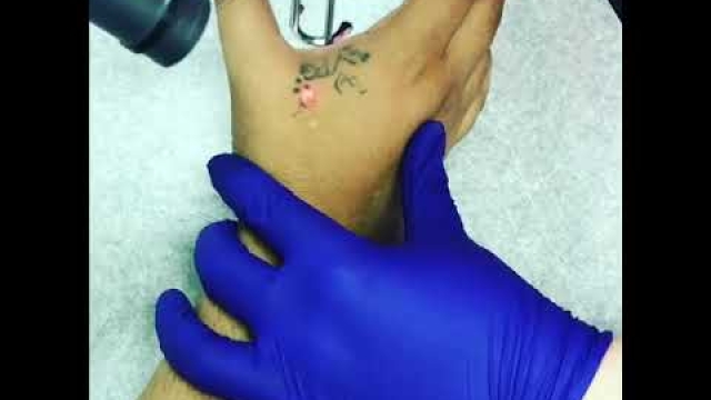 Tattoo Removal: Options For Getting That Tattoo You Regret Removed