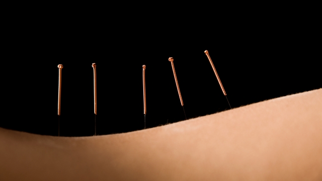 The Art of Needle Healing: Unveiling the Power of Acupuncture