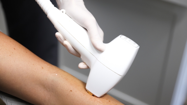 Laser Hair Removal: Unveiling the Smoothest Solution