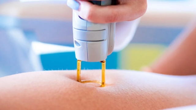 Laser Hair Removal: Unveiling the Smoothest Path to Silky Skin